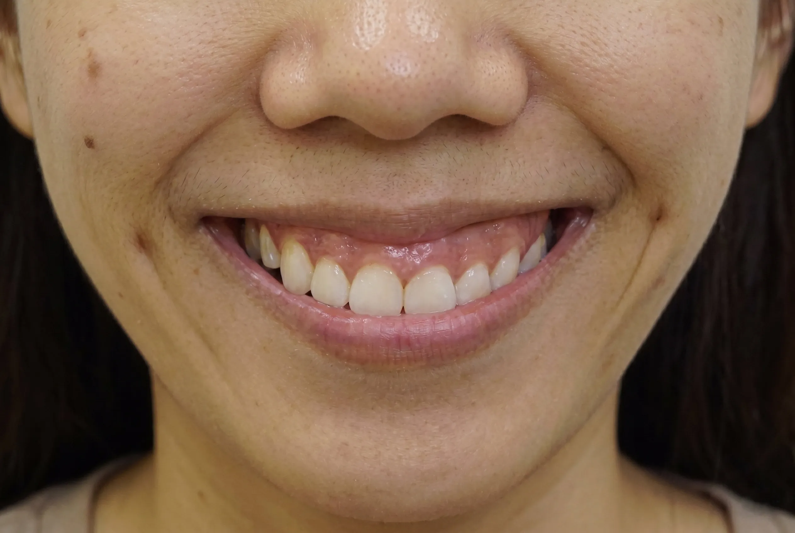 Gummy Smile Treatment - Before